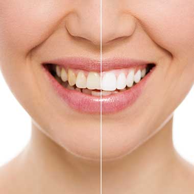 The image shows a close-up view of a person s face with a smile, displaying teeth before and after dental treatment, highlighting the transformation achieved through cosmetic dentistry.
