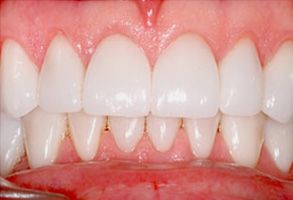 This image shows a close-up view of a person s teeth with an emphasis on their bright white color and cleanliness, which suggests dental hygiene.