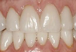 The image shows a close-up view of a person s teeth with visible signs of yellowing or discoloration, likely due to staining or aging.
