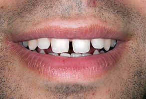 The image shows a close-up of a person with a large smile revealing their teeth and gums, with a focus on a missing tooth in the front row.